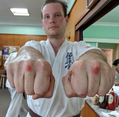 skinned knuckles